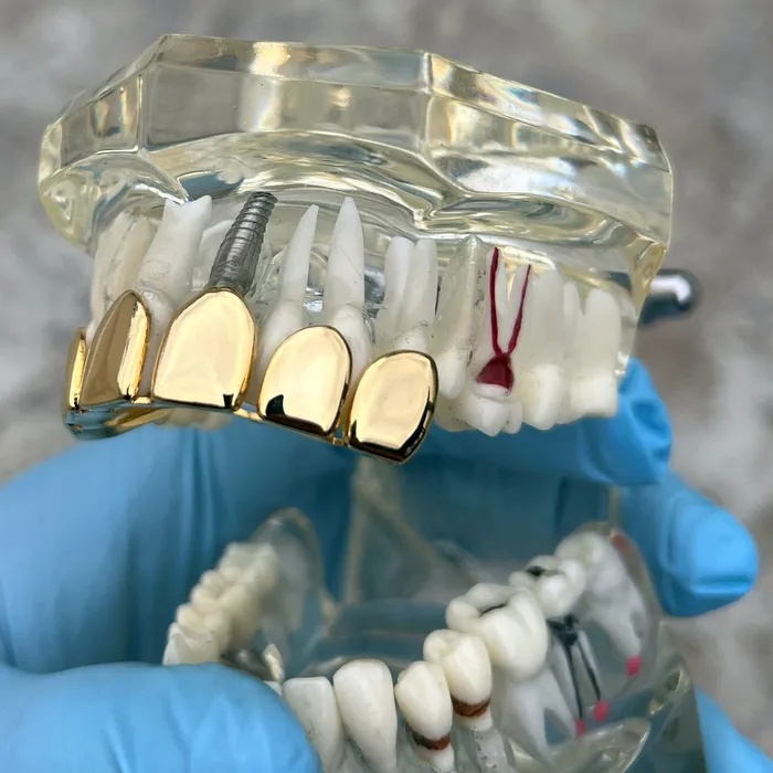 Earrings Bling Cartel Admin 14K Gold Plated Permanent Cut Perm Cuts Top Teeth PreMade Grillz